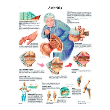 Fabrication Enterprises 3B Anatomical Chart - Arthritis, Laminated 12-4605L